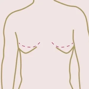 Gynecomastia - Chest